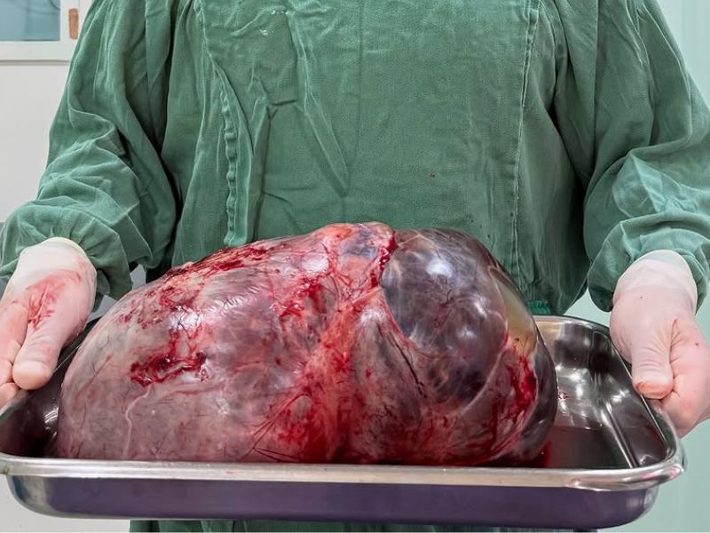 Cirurgia é realizada com sucesso e paciente de Rio das Ostra tem tumor gigante de 15kg retirado