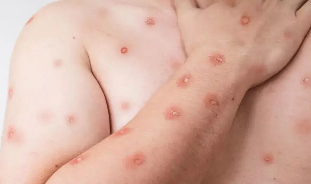 Araruama esclarece relatório estadual e descarta casos de mpox no município