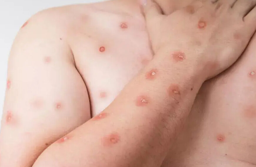 Araruama esclarece relatório estadual e descarta casos de mpox no município