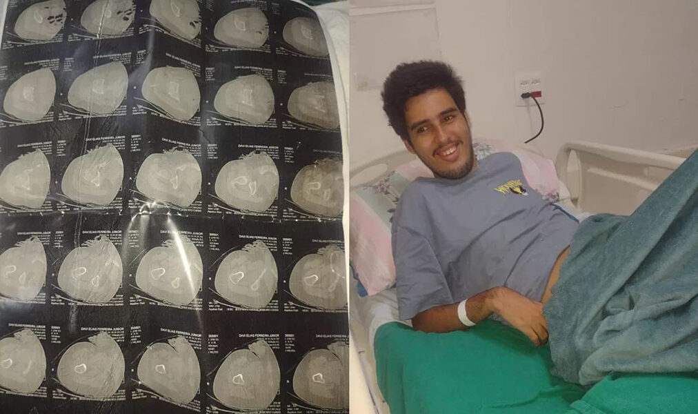 Agressão em escola de Cabo Frio levanta questionamentos sobre segurança de aluno autista